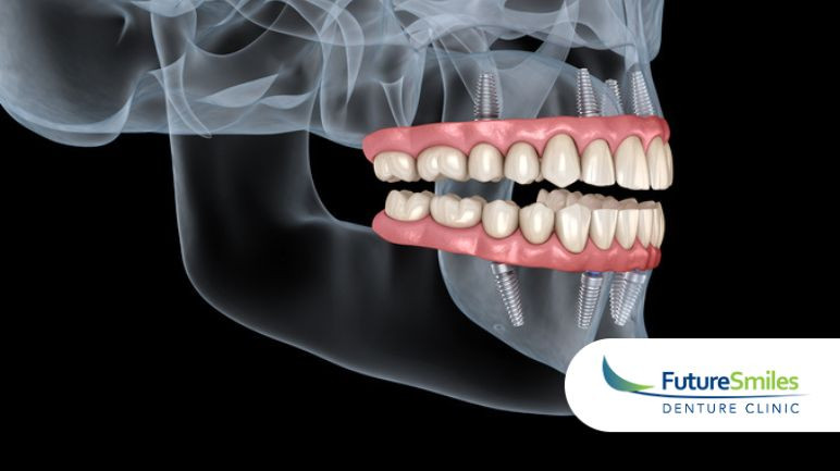 How Denture Implants Can Save Your Jawbone